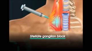 stellate ganglion block [upl. by Anavoig]