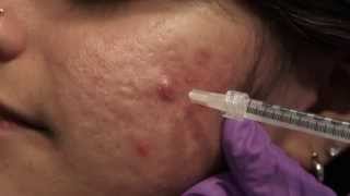 Watch amp Learn Intralesional injections [upl. by Tioneb]