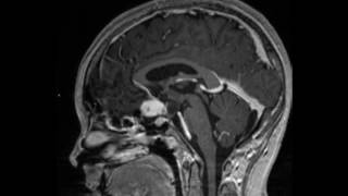 Optic nerve glioma [upl. by Hachmin543]