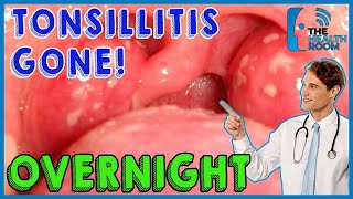 10 Effective Tonsillitis Home Remedies That Work Fast [upl. by Daria649]