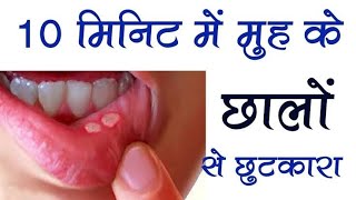 मुँह के छाले Mouth Ulcer से तुरंत राहत Becosule Capsule  Oraheal Tablet [upl. by Kirkpatrick474]