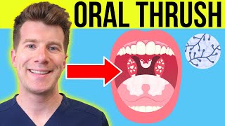 Doctor explains ORAL THRUSH Oral Candidiasis  Symptoms treatment amp prevention in adultsbabies [upl. by Eerahs]