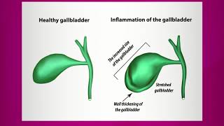 Pain Caused by Gallbladder Inflammation [upl. by Resee]