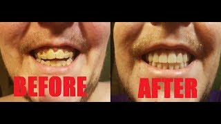 EdayDay 1 Before and After Dentures  Denture Vlog [upl. by Ailenroc]