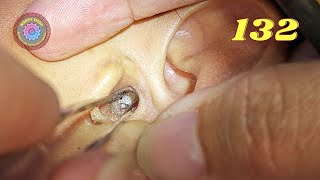 Tập 132 Lấy ráy tai không khó Removing earwax is not difficult layraytai ear [upl. by Seidule]