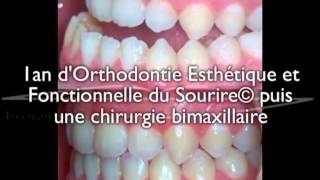 Chirurgie bimaxillaire pour un jeune adulte  correction avec 1an daligneurs® en OEFS© [upl. by Balch]