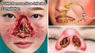 ASMR Remove Nose Infected Compilation  Deep Cleaning Animation [upl. by Nahtnamas]