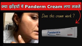 Does Panderm Cream work for Melasma क्या झाँइयों में Panderm Cream लगा सकते हैं [upl. by Ellenad]