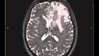 Grade 3 Anaplastic Astrocytoma [upl. by Netsirc]