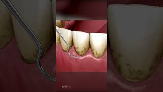 AMSR Tarter Removal Dental Cleaning to Remove Plaque amp Tarter Buildup [upl. by Oates772]