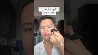 Derma Stamp for ACNE SCARS reels skincare acnetreatment acnejourney skincareroutine acnes [upl. by Deryl130]