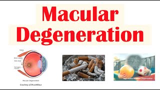 Macular Degeneration  Wet vs Dry  Risk Factors Pathophysiology Symptoms Diagnosis Treatment [upl. by Hanschen]