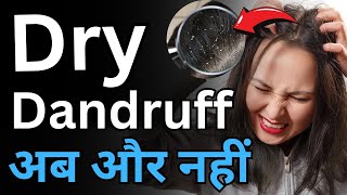 इन आयुर्वेदिक तरीको से ड्राई डेंड्रफ होगा जड़ से खत्म  Ayurveda Treatment big DRY DANDRUFF [upl. by Dimitry449]