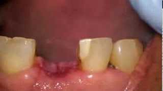 Suture removal after a dental implant placement [upl. by Kapeed]