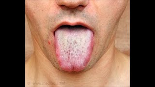 ORAL CANDIDIASIS Oral Thrush Causes Symptoms How To Treat White Tongue [upl. by Mott]