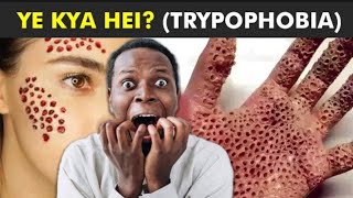 Trypophobia  Fear Of Holes trypophobia fear of holes in skin [upl. by Neelra]