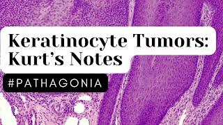 Keratinocyte Tumors Kurt’s Notes pathagonia [upl. by Jestude]