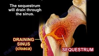 Bone Infection Osteomyelitis Briefly  Everything You Need To Know  Dr Nabil Ebraheim [upl. by Derte167]