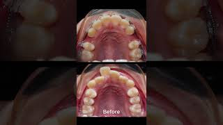 Braces proces  tooth extraction fix overbite teeth [upl. by Hughmanick]