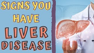 SIGNS THAT YOU HAVE A LIVER DISEASE liver disease signs and symptoms [upl. by Aihtak]