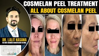 COSMELAN PEEL TREATMENT  ALL ABOUT COSMELAN PEEL  BY DRLALIT KASANA [upl. by Kho]