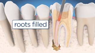 Root Canal Retreatment Explained [upl. by Borras]