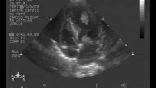 echocardiogram multiple rhabdomyoma tumor apical 4 chambers view [upl. by Nahshu425]