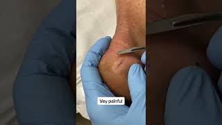 Painful cracked heel and callus removal with scalpel from the feet by austraian podiatrist corn ca [upl. by Sirap]