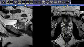 How to read a Prostate MRI [upl. by Dinah]