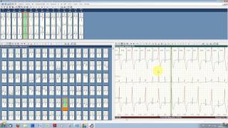 Typcial ECG analysis with ECGpro Holter 743 [upl. by Ylebmik729]