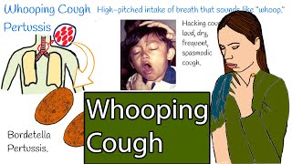 Whooping cough  Pertussis Hacking cough Symptoms and treatment [upl. by Atikat]