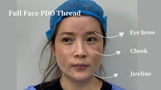 Facial Contouring Non Surgical Procedure PDO Threads for Cheek Jawline Eyebrow [upl. by Edik996]