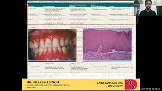 BDS 406 PERIODONTOLOGY DESQUAMATIVE GINGIVITIS DR NEELESH SINGH [upl. by Auj]