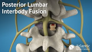 Posterior Lumbar Interbody Fusion PLIF [upl. by Alyakcm]