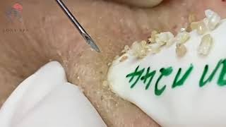 Inflamed Acne Under Skin  Blackhead Extraction  Blackhead Removal  14 [upl. by Naujed]