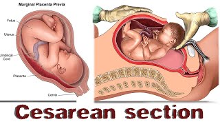 CSECTION Cesarean Delivery  CESAREAN SECTION DELIVERY [upl. by Cilka]