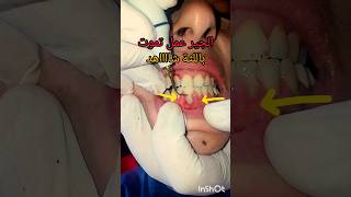 جير اسنان سبب التهاب اللثه وخلخلة الاسنان علاج في عيادة طبيب الاسنان dentist اكسبلور stitch [upl. by Remy575]