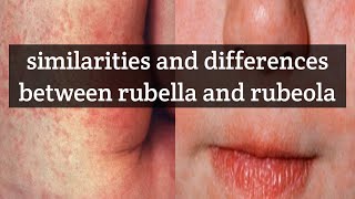 Similarities and differences between rubeola and rubella  an nclex topic [upl. by Florry508]