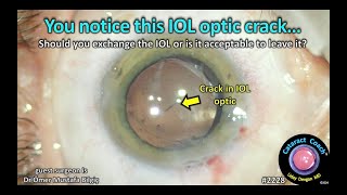 CataractCoach™ 2228 you notice this IOL optic crack [upl. by Haily740]