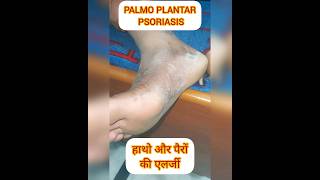 PALMOPLANTAR PSORIASIS psoriasis itching dryskin shortsfeed shortvideo shorts ytviral SHORT [upl. by Barret]