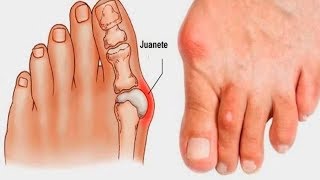 Vendaje para Juanete o hallux valgus ojo de pescado [upl. by Aleda]