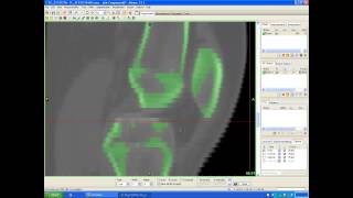 Processing a DICOM file to 3D using Mimics [upl. by Leslee]