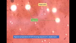 Cryptococcus capsules in Nigrosin preparation [upl. by Vander]