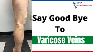 Varicose veins  Treating Varicose veins without surgery in hyderabad [upl. by Farrah540]