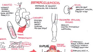 Atherosclerosis  Pathophysiology [upl. by Ydniahs]