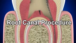 Root Canal Procedure [upl. by Erodoeht]