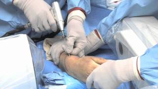 Broken wrist treated with the CPX by AM Surgical [upl. by Natsirt]