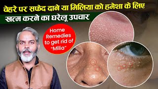 गर्मी में चेहरे पर निकलने वाले सफेद दाने या मिलिया के लिए घरेलू उपाय  Home Remedies for Milia [upl. by Evadnee]