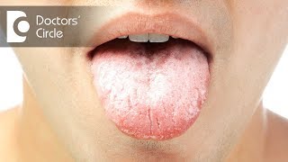 Causes and symptoms of oral thrush  Dr Jayaprakash Ittigi [upl. by Aitsirhc]