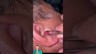 DrNatacha satisfying earwax removal [upl. by Sabella340]